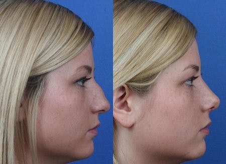 Rhinoplasty/NatraNose Before & After Gallery - Patient 37904869 - Image 2