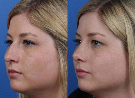 Rhinoplasty/NatraNose Before & After Gallery - Patient 37904869 - Image 3