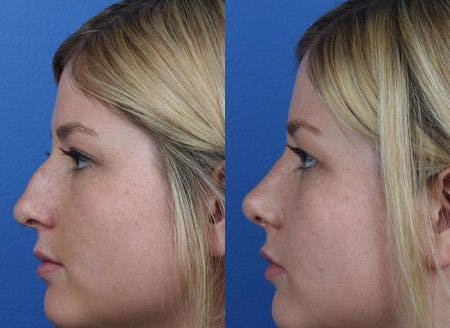 Rhinoplasty/NatraNose Before & After Gallery - Patient 37904869 - Image 4