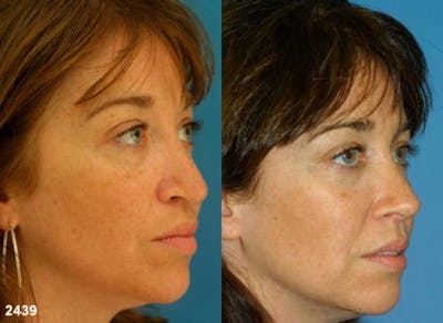 Rhinoplasty/NatraNose Before & After Gallery - Patient 37904874 - Image 1