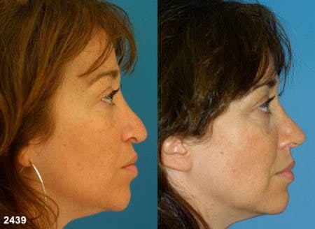 Rhinoplasty/NatraNose Before & After Gallery - Patient 37904874 - Image 2