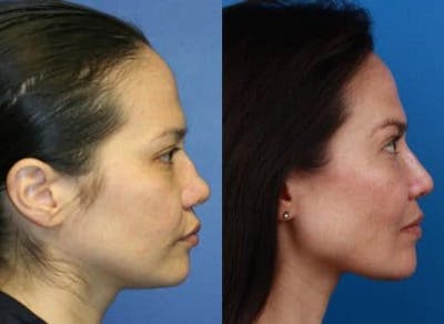 Rhinoplasty/NatraNose Before & After Gallery - Patient 37904877 - Image 1