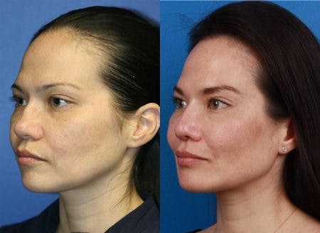Rhinoplasty/NatraNose Before & After Gallery - Patient 37904877 - Image 2