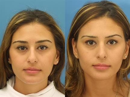 Rhinoplasty/NatraNose Before & After Gallery - Patient 37904879 - Image 2