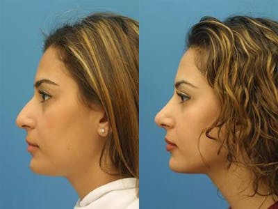 Rhinoplasty/NatraNose Before & After Gallery - Patient 37904879 - Image 1
