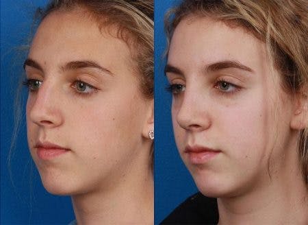 Rhinoplasty/NatraNose Before & After Gallery - Patient 37904881 - Image 2