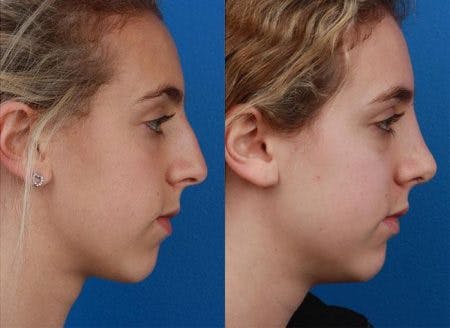 Rhinoplasty/NatraNose Before & After Gallery - Patient 37904881 - Image 3