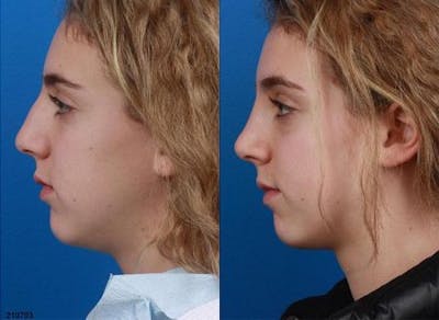 Rhinoplasty/NatraNose Before & After Gallery - Patient 37904881 - Image 1