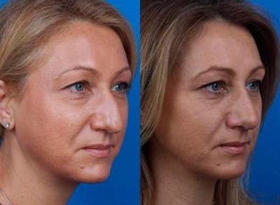 Rhinoplasty/NatraNose Before & After Gallery - Patient 37904885 - Image 1