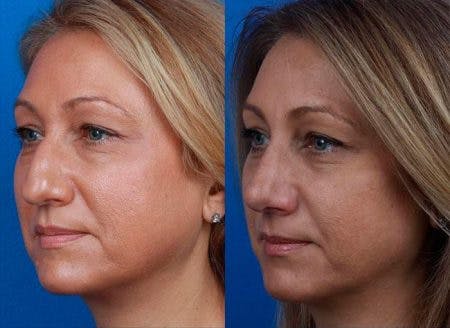 Rhinoplasty/NatraNose Before & After Gallery - Patient 37904885 - Image 2