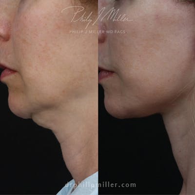 Neck Lift Before & After Gallery - Patient 91712487 - Image 1