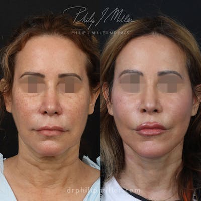 Facelift/NatraLift Before & After Gallery - Patient 91731030 - Image 1