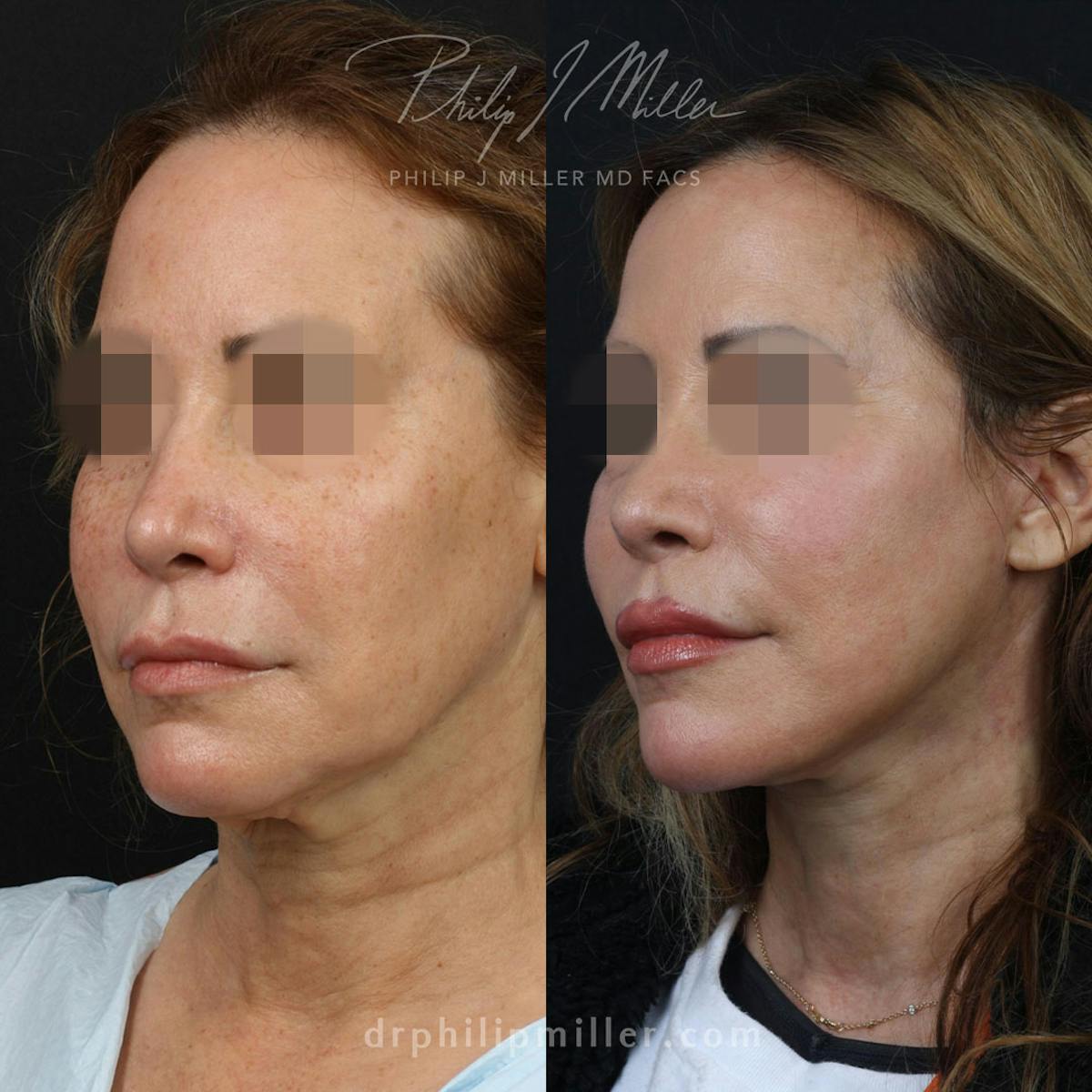 Facelift/NatraLift Before & After Gallery - Patient 91731030 - Image 2