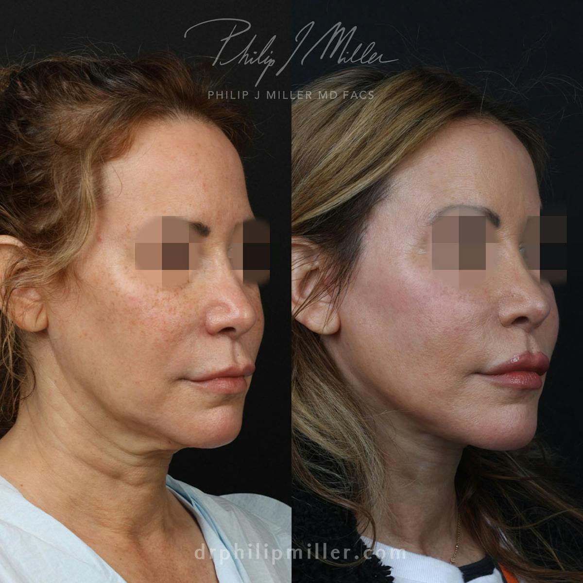 Facelift/NatraLift Before & After Gallery - Patient 91731030 - Image 3
