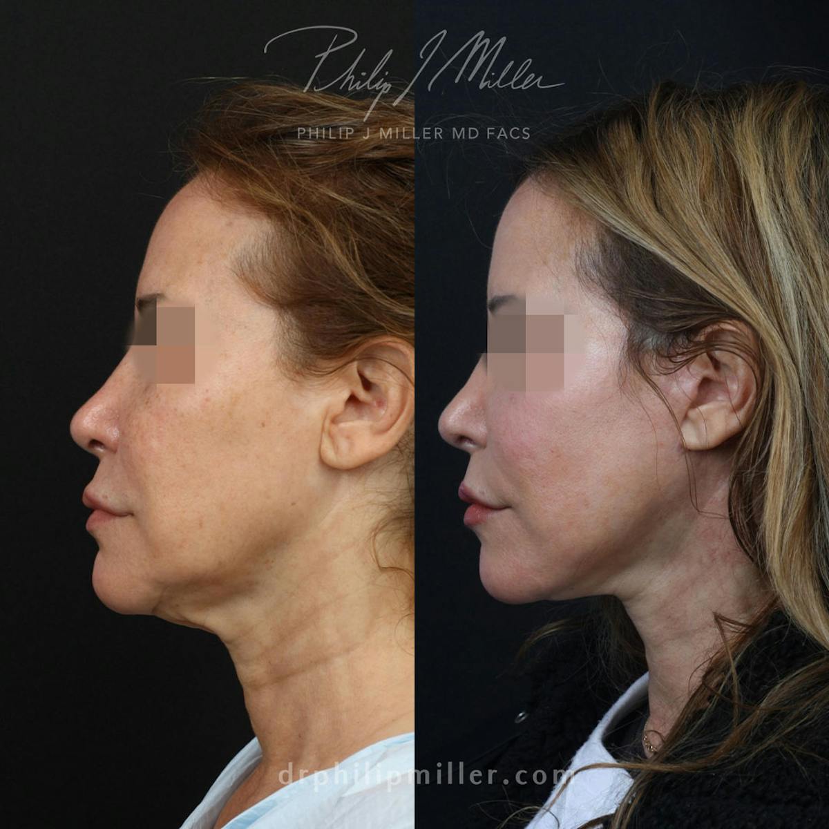 Facelift/NatraLift Before & After Gallery - Patient 91731030 - Image 4