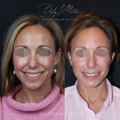 Facelift/NatraLift Before & After Gallery - Patient 91731033 - Image 1