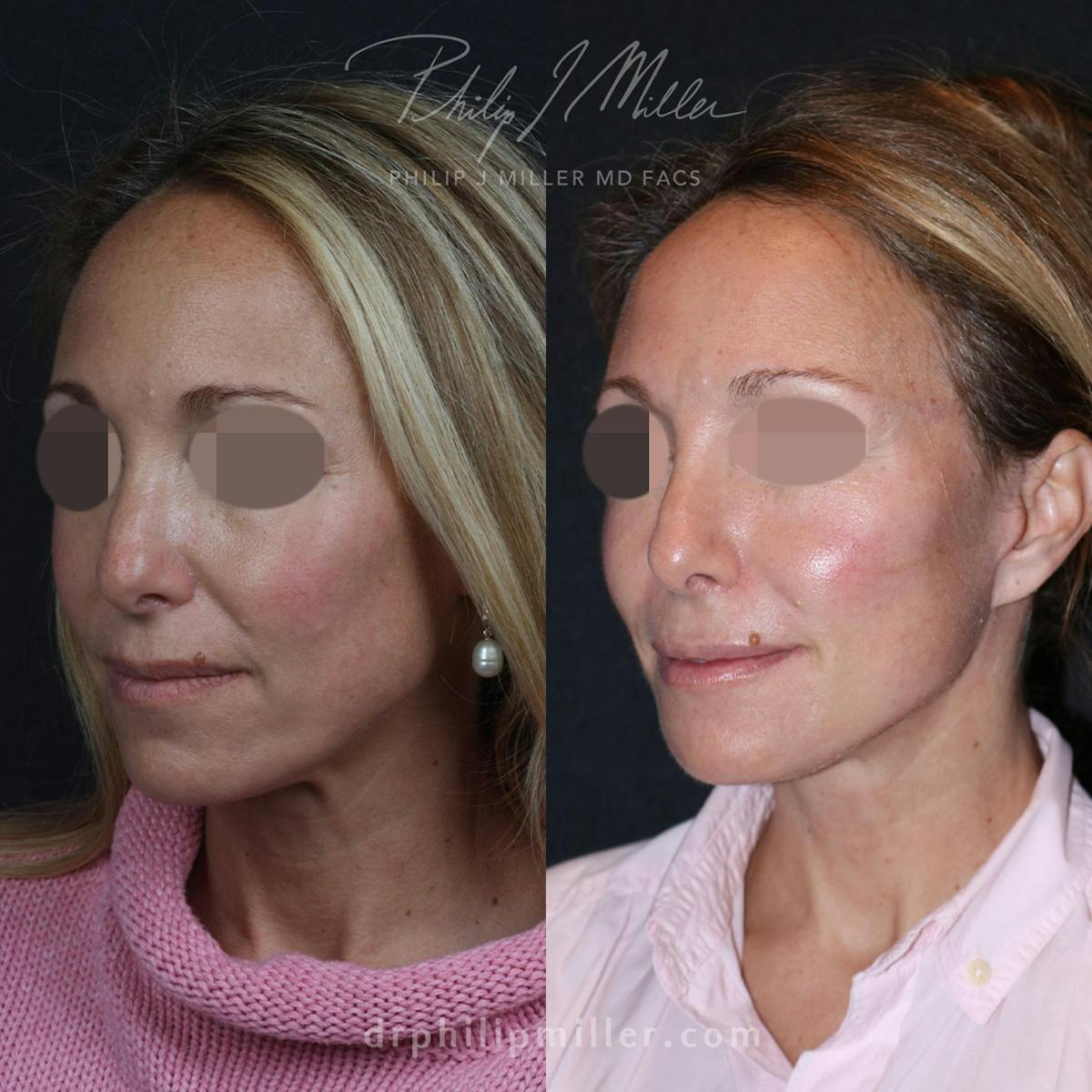 Facelift/NatraLift Before & After Gallery - Patient 91731033 - Image 2