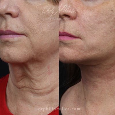 Facelift/NatraLift Before & After Gallery - Patient 91731049 - Image 1