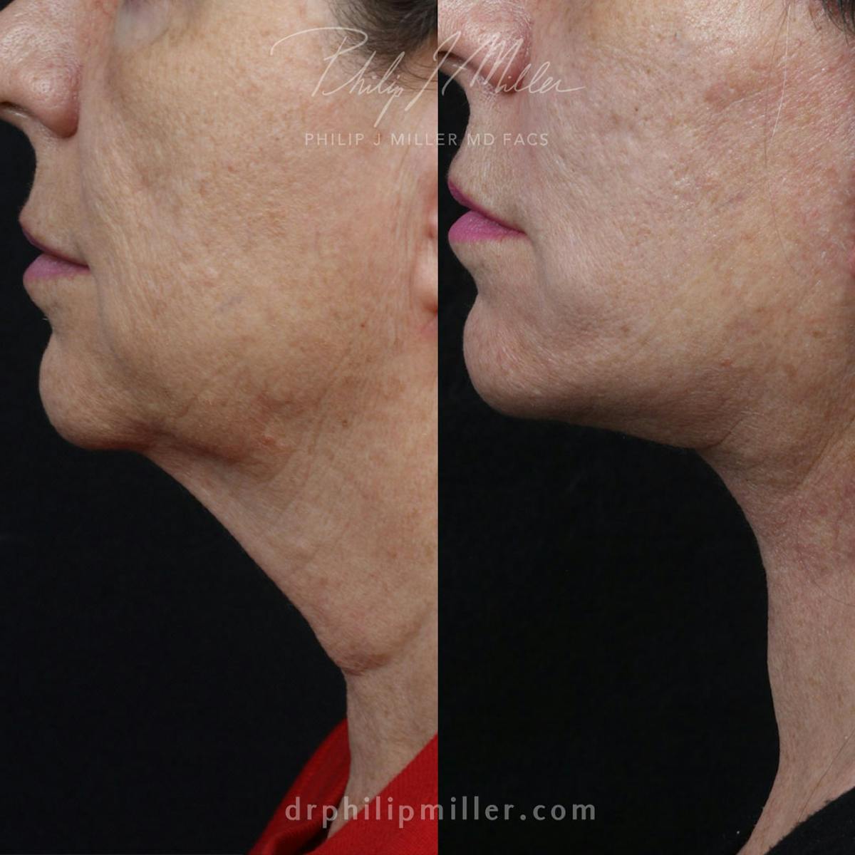 Facelift/NatraLift Before & After Gallery - Patient 91731049 - Image 2