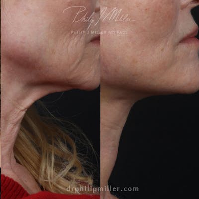 Facelift/NatraLift Before & After Gallery - Patient 91731057 - Image 1