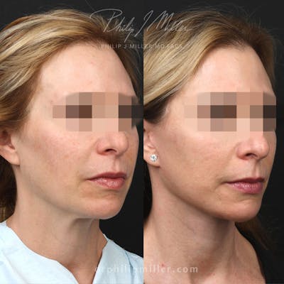 Facelift/NatraLift Before & After Gallery - Patient 115853531 - Image 1