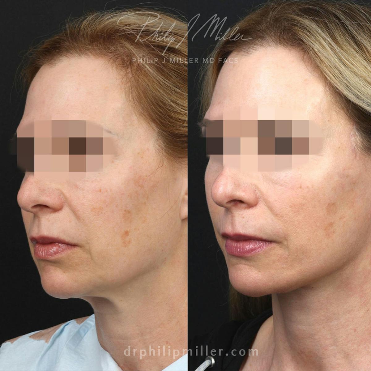 Facelift/NatraLift Before & After Gallery - Patient 115853531 - Image 2