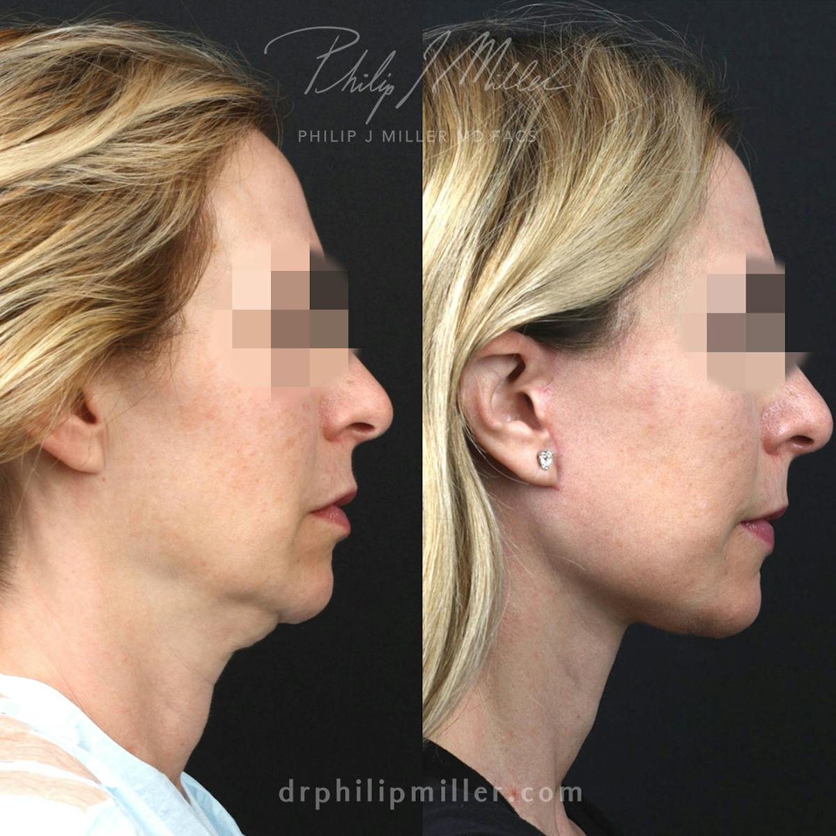 Facelift/NatraLift Before & After Gallery - Patient 115853531 - Image 3