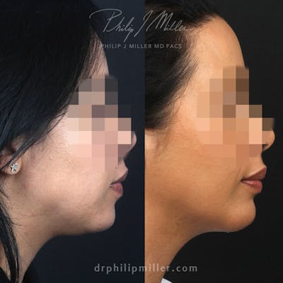 G. I. Jaw/Chin Contouring Before & After Gallery - Patient 115853724 - Image 1