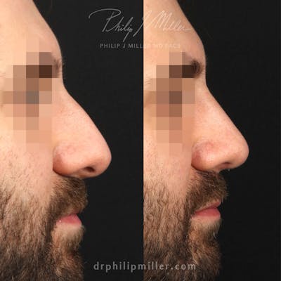 Rhinoplasty/NatraNose Before & After Gallery - Patient 122169832 - Image 1