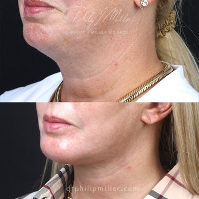Facelift/NatraLift Before & After Gallery - Patient 122169887 - Image 1