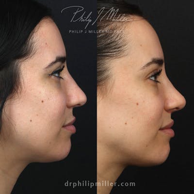 Rhinoplasty/NatraNose Before & After Gallery - Patient 133255333 - Image 1