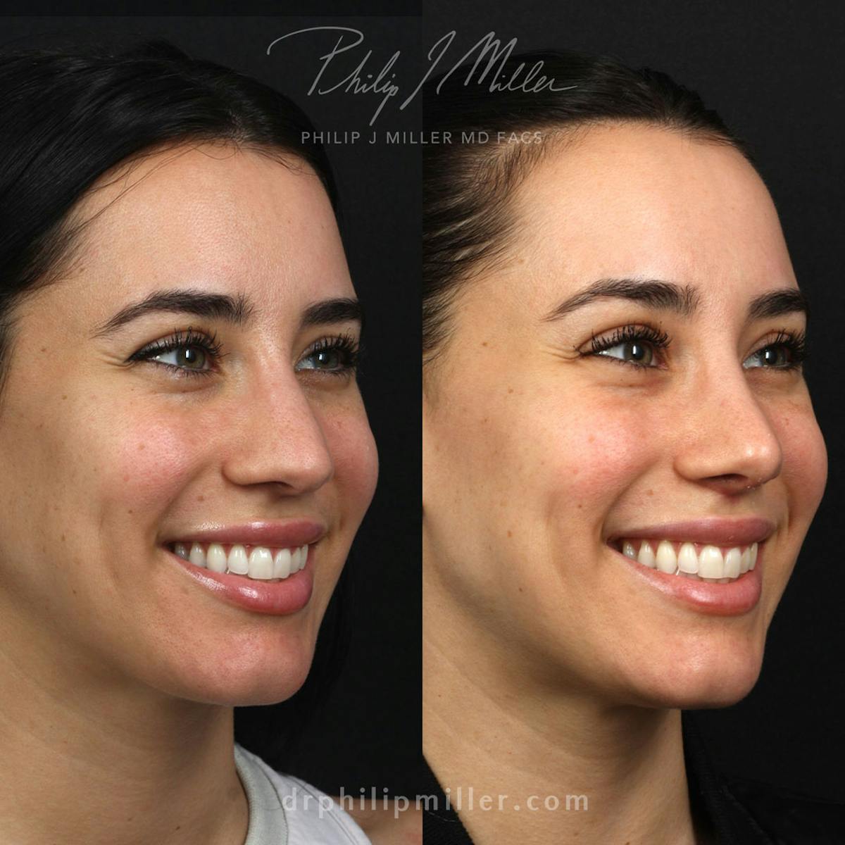 Lip Enhancement Before & After Gallery - Patient 133255347 - Image 1
