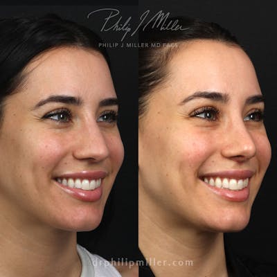 Lip Enhancement Before & After Gallery - Patient 133255347 - Image 1