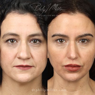 Rhinoplasty/NatraNose Before & After Gallery - Patient 133466111 - Image 1