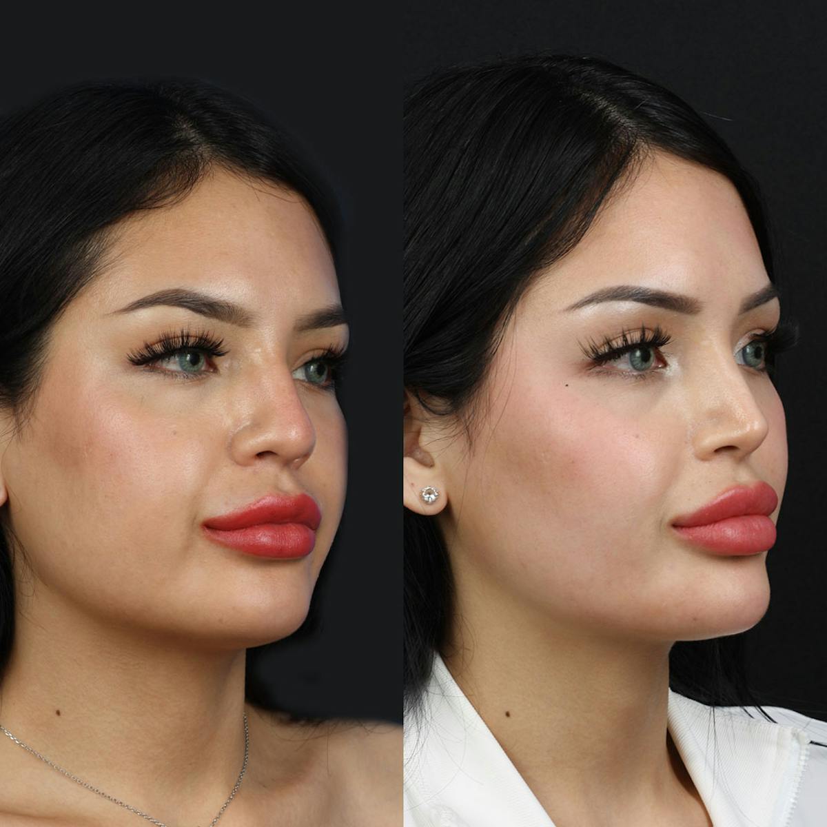 Buccal Fat Removal Before & After Gallery - Patient 148813725 - Image 2