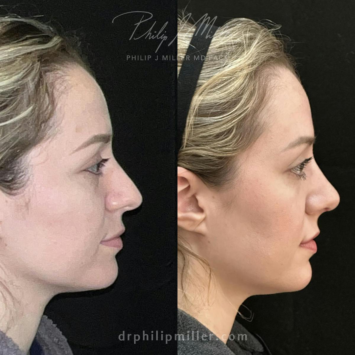 Rhinoplasty/NatraNose Before & After Gallery - Patient 148813770 - Image 3