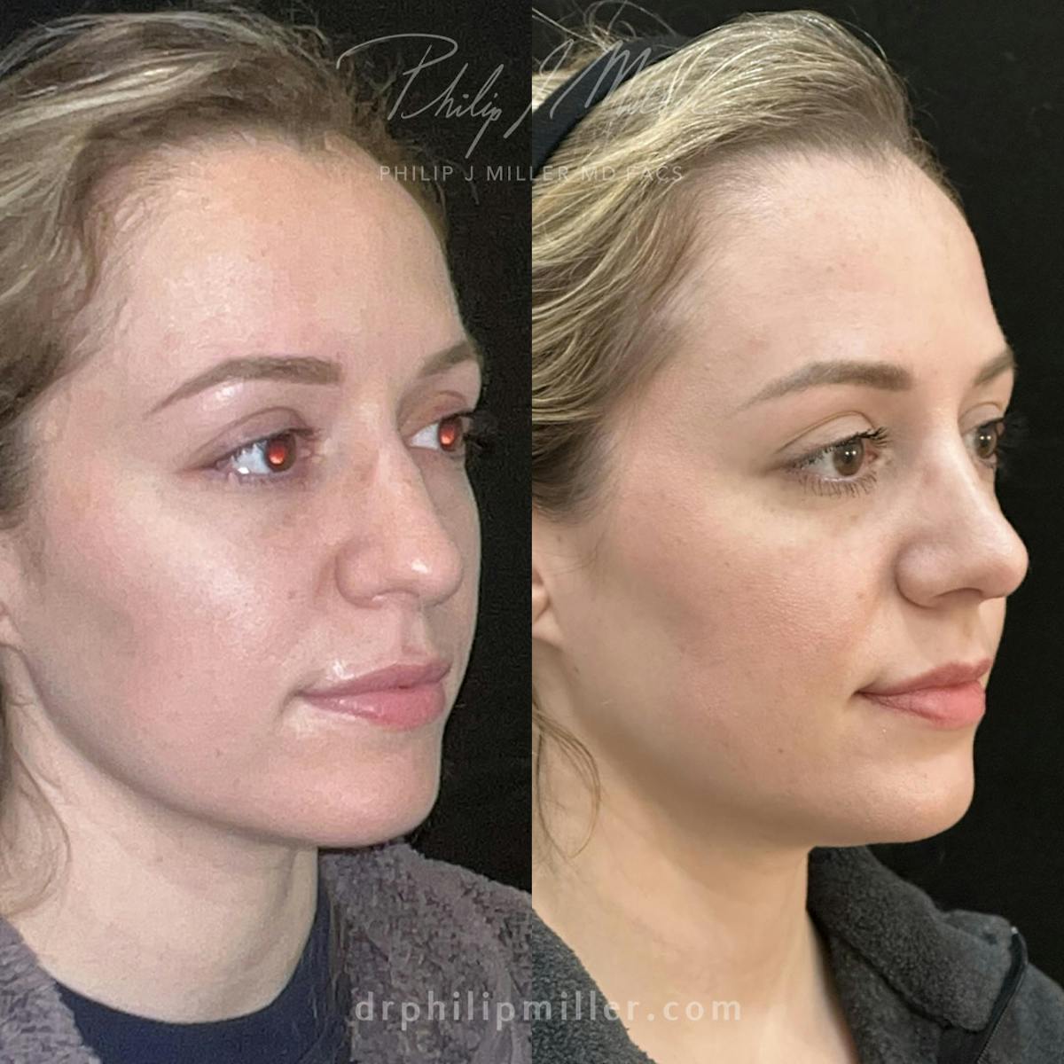 Rhinoplasty/NatraNose Before & After Gallery - Patient 148813770 - Image 2