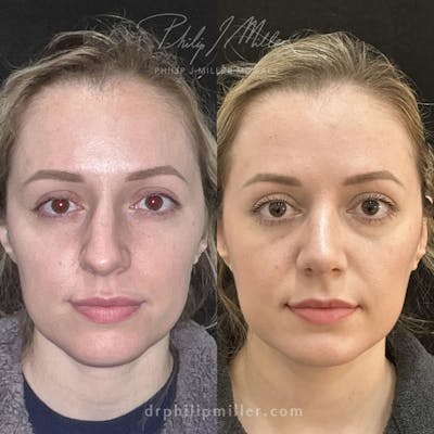 Rhinoplasty/NatraNose Before & After Gallery - Patient 148813770 - Image 1