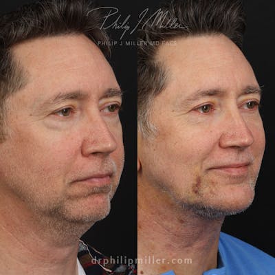 Facelift/NatraLift Before & After Gallery - Patient 159945261 - Image 1