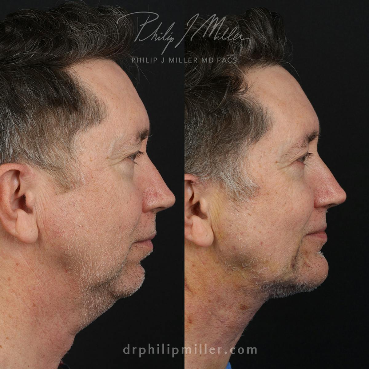 Facelift/NatraLift Before & After Gallery - Patient 159945261 - Image 2
