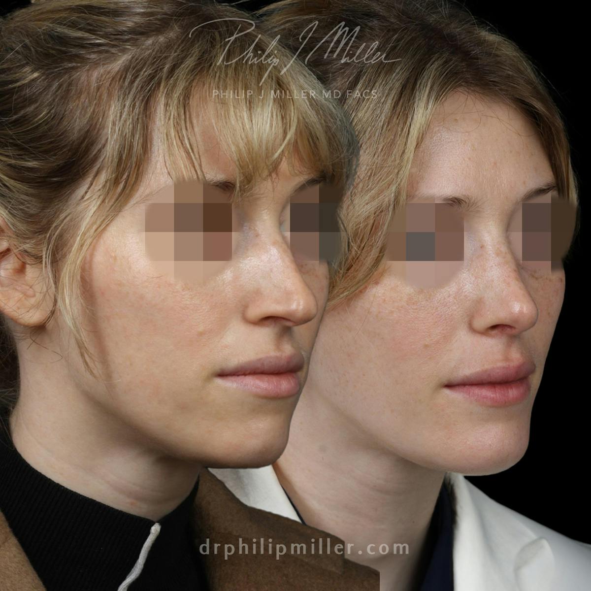 G. I. Jaw/Chin Contouring Before & After Gallery - Patient 164233775 - Image 2