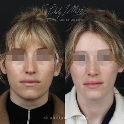 Rhinoplasty/NatraNose Before & After Gallery - Patient 164233747 - Image 1