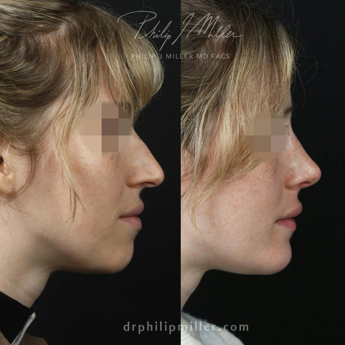Rhinoplasty/NatraNose Before & After Gallery - Patient 164233747 - Image 3