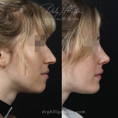 G. I. Jaw/Chin Contouring Before & After Gallery - Patient 164233775 - Image 1