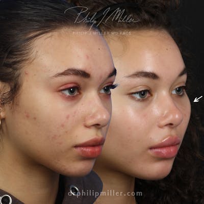 Cheek Implants Before & After Gallery - Patient 164233878 - Image 1