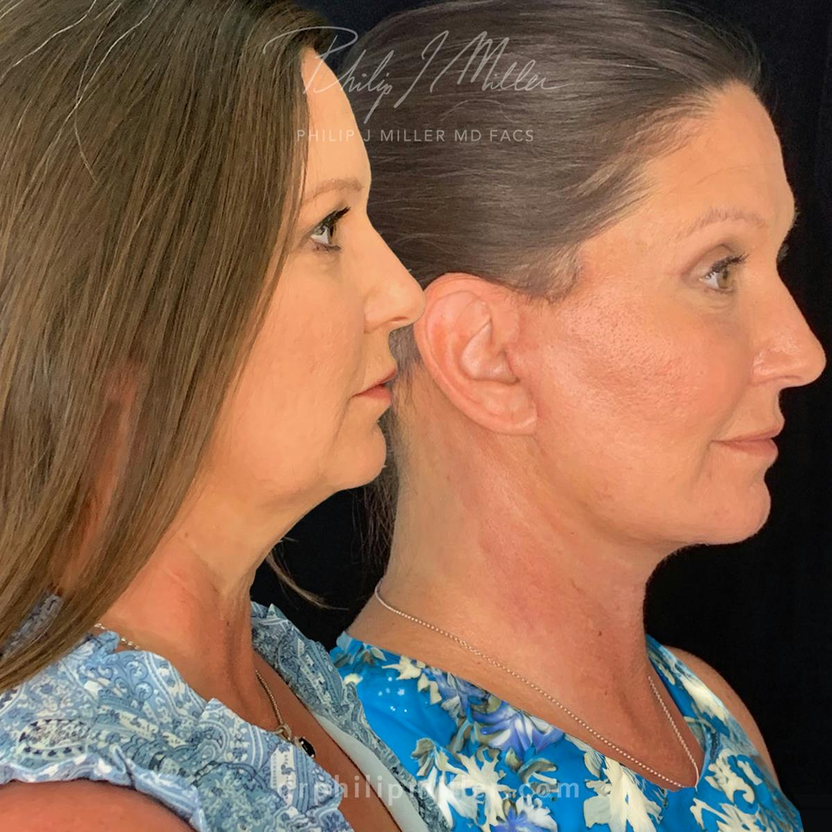 Facelift/NatraLift Before & After Gallery - Patient 165340100 - Image 1