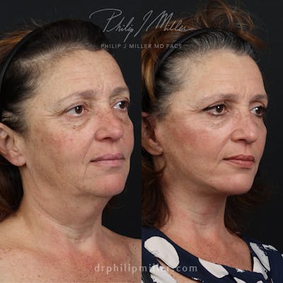 Facelift/NatraLift Before & After Gallery - Patient 165608181 - Image 1