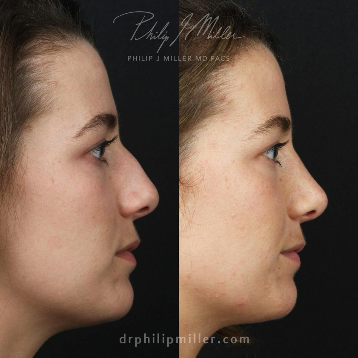 Rhinoplasty/NatraNose Before & After Gallery - Patient 168196171 - Image 3