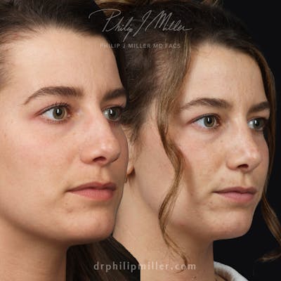 Rhinoplasty/NatraNose Before & After Gallery - Patient 168196171 - Image 1