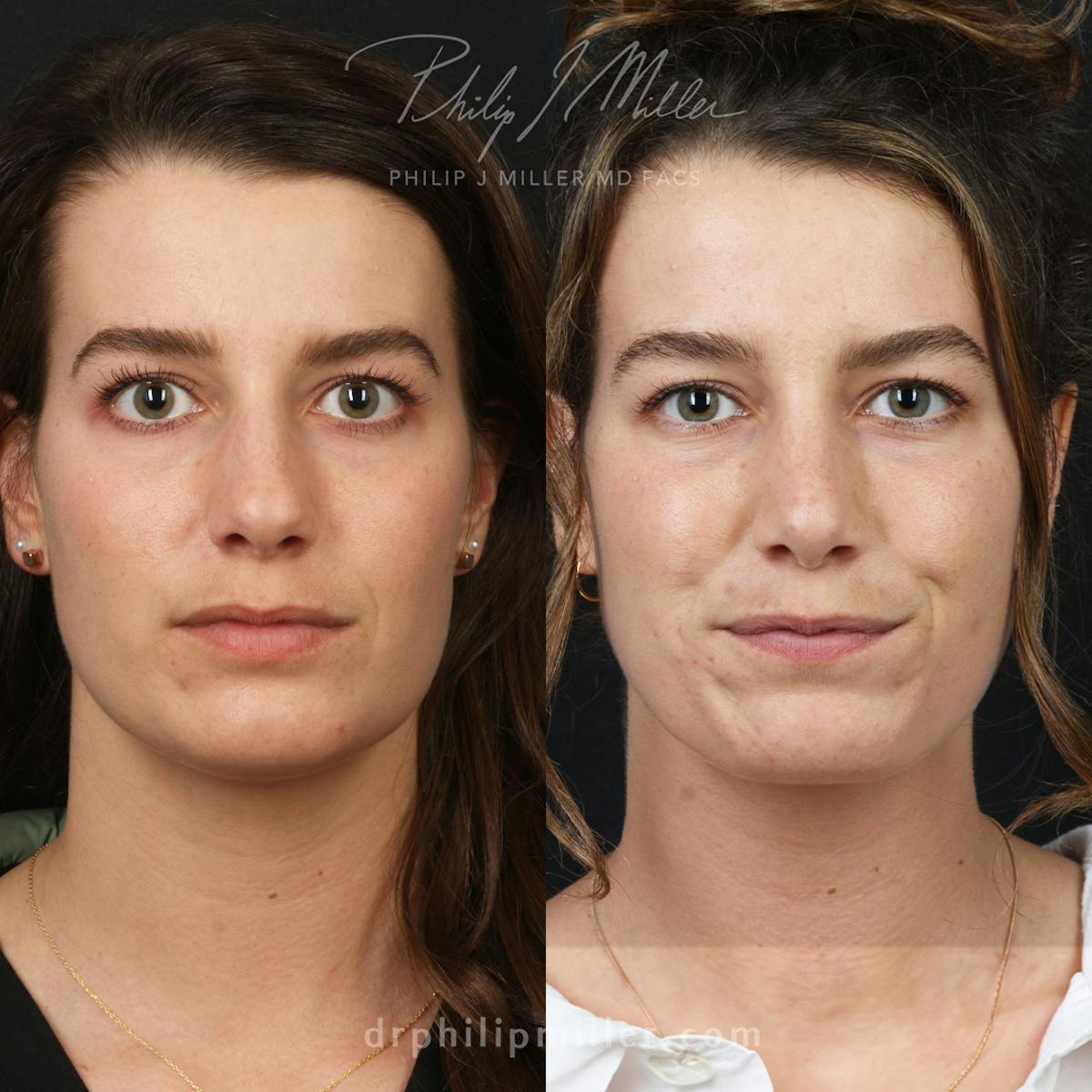 Rhinoplasty/NatraNose Before & After Gallery - Patient 168196171 - Image 2